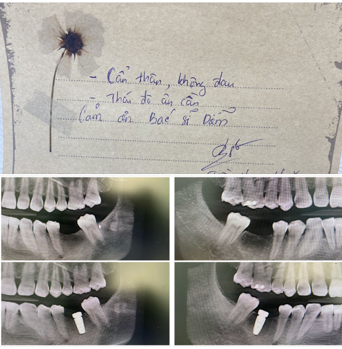  Một ca đặt Implant chuẩn mực của bác sĩ Diễm, chi nhánh 292 Huỳnh Văn Bánh, Q.PN!