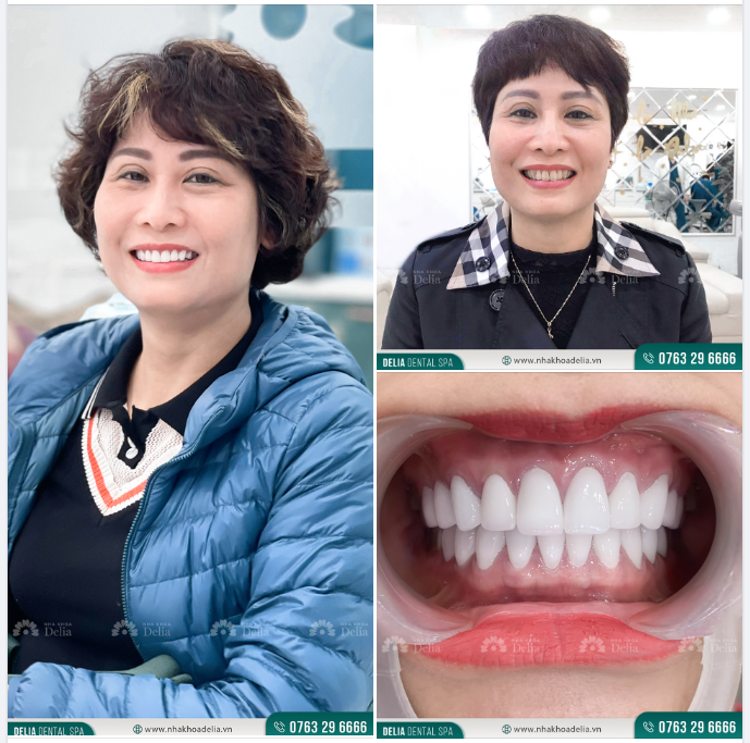 "Chỉ cần làm răng sứ, nụ cười bỗng trẻ hóa bất ngờ"