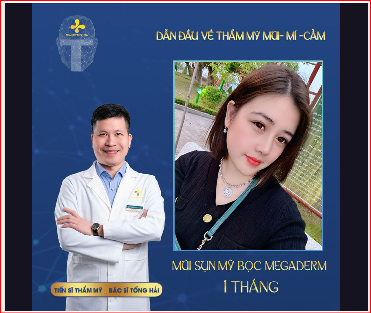 Tháng mới chúc chị em thêm xinh đẹp, nhiều lộc lá! Mời chị em xem ảnh kết quả sau 1 tháng nâng mũi, dịch vụ Nâng mũi sụn Mỹ bọc Megaderm.