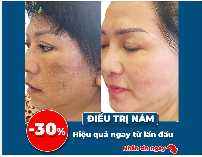 ĐÁNH BẬT SẮC TỐ NÁM, TRẢ LẠI LÀN DA ĐỀU MÀU ĐẦY SỨC SỐNG