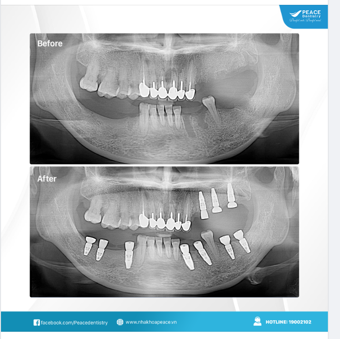 TRỒNG IMPLANT TỪ SỚM MANG LẠI NHIỀU LỢI ÍCH VƯỢT TRỘI: