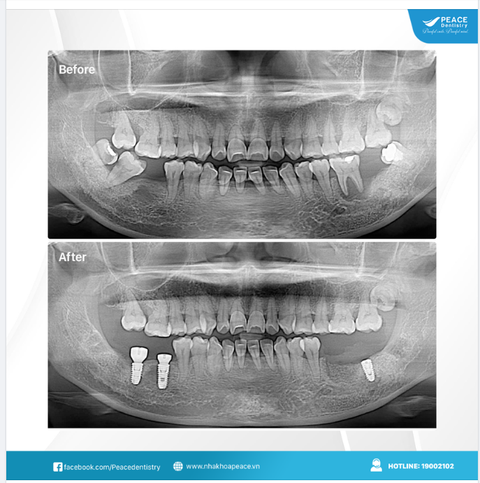 Cấy ghép implant từ sớm, ngay khi răng của bạn được dự báo "sẽ mất răng trong tương lại gần".