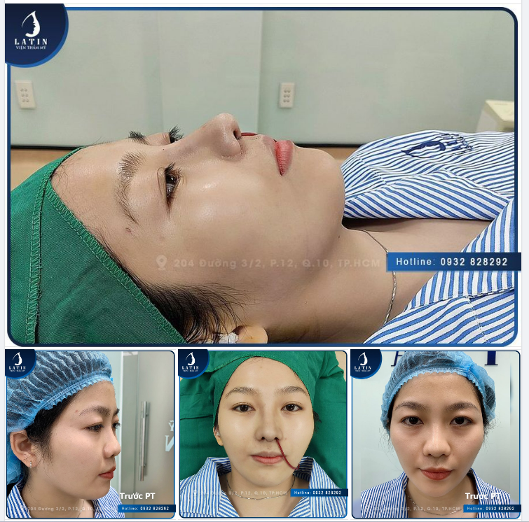Khắc phục dáng mũi thấp cho em gái. Mũi cấu trúc sửa lại