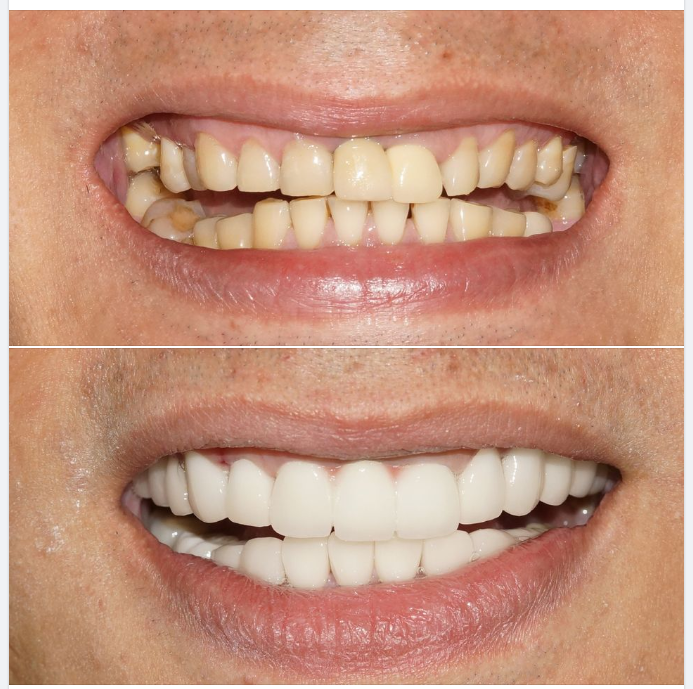 Một trường hợp phục hình răng sứ bởi bác sĩ Tú, chi nhánh 149 Tôn Dật Tiên, Q.7!