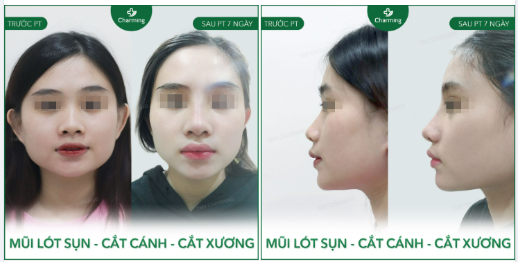 Nhìn sơ dáng mũi cứ nghĩ đơn giản là chỉ cần nâng lên thôi là lầm to ​​​​​​​