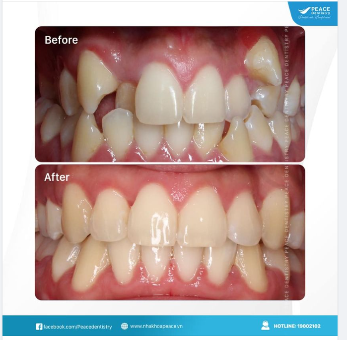 Ca lâm sàng Niềng răng mắc cài tự đóng cho khách hàng nam 20 tuổi