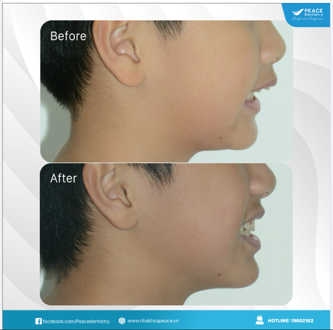 Ca lâm sàng niềng răng chỉnh hô mắc cài kim loại cho bạn nam tuổi teen
