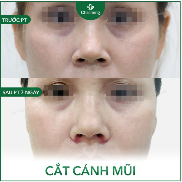Khi cánh mũi to bè, bạn muốn mũi gọn gàng hơn nhưng lại không muốn nâng mũi, vậy thì bạn đừng lo.