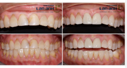 Khách hàng đến vì răng cửa có miếng trám lớn bị đổi màu, cần cải thiện màu răng và form răng dài hơn răng cũ.