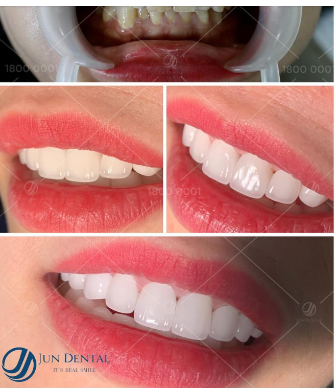 Răng sứ tự nhiên đến mức không ai phát hiện ra làm răng là có thật…