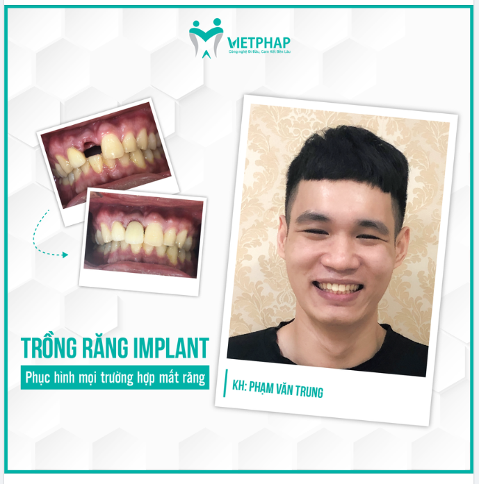 PHỤC HÌNH CHIẾC RĂNG HÀNG TIỀN ĐẠO CHO CHÀNG TRAI TRẺ NHỜ PHƯƠNG PHÁP CẤY IMPLANT