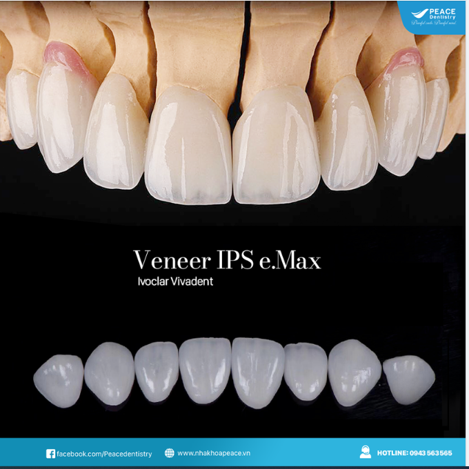 Một vài TIPS chia sẻ kinh nghiệm khi làm mặt dán sứ Veneer từ Peace Dentistry