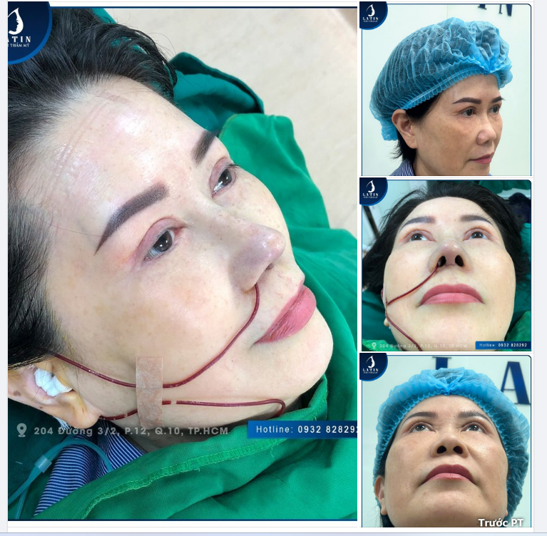 Dáng mũi tự nhiên cho chị khách hàng Việt kiều Úc