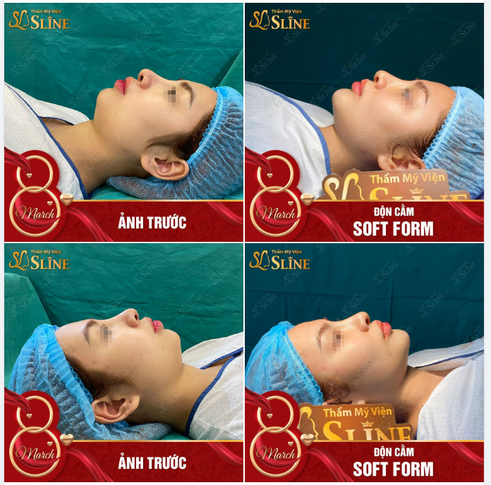 “ Độn cằm Soft form vừa xong thôi mà em đã thấy rất ưng vì nhìn mặt thanh thoát hẳn, đường nét mềm mại, tự nhiên, làm còn nhanh nữa.”