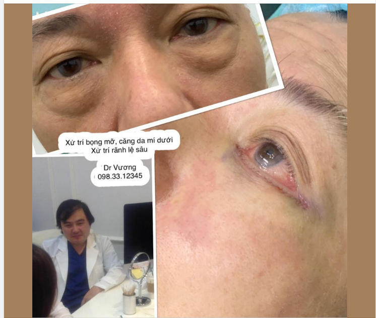 Trẻ hoá vùng mí dưới cho anh khách đến từ Singapore