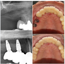 Một trường hợp đặt 2 trụ Implant và phục hình răng trên implant do Bác sĩ Minh Tú - chi nhánh Tôn Dật Tiên - Quận 7