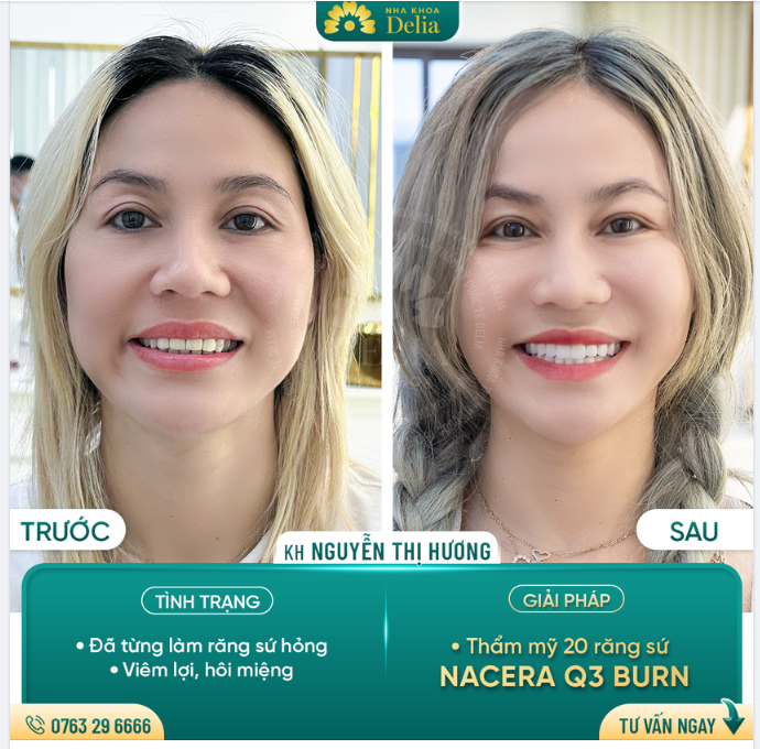 Chỉ 2 lần hẹn - Delia giải cứu thành công răng sứ hỏng cho chị Hương