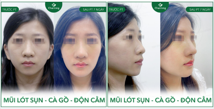 Nhiều người muốn mũi cao mà không có, nhưng người có mũi cao mà có thêm gồ mũi thì có mà cũng như không
