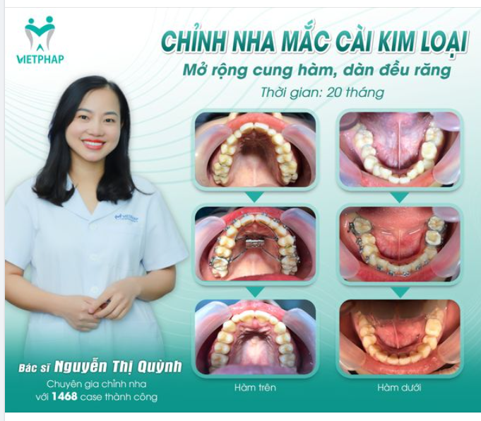 TẠI SAO PHẢI NONG HÀM KHI NIỀNG RĂNG?