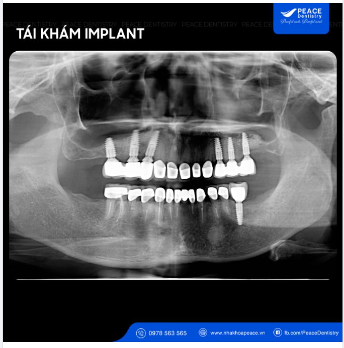 TÁI KHÁM ĐỊNH KỲ - BÍ QUYẾT BẢO VỆ RĂNG IMPLANT CHẮC KHỎE ỔN ĐỊNH LÂU DÀI