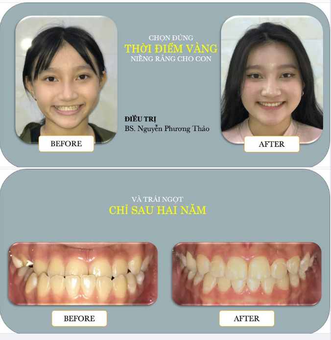 THỜI ĐIỂM “VÀNG” ĐỂ NIỀNG RĂNG CHO TRẺ