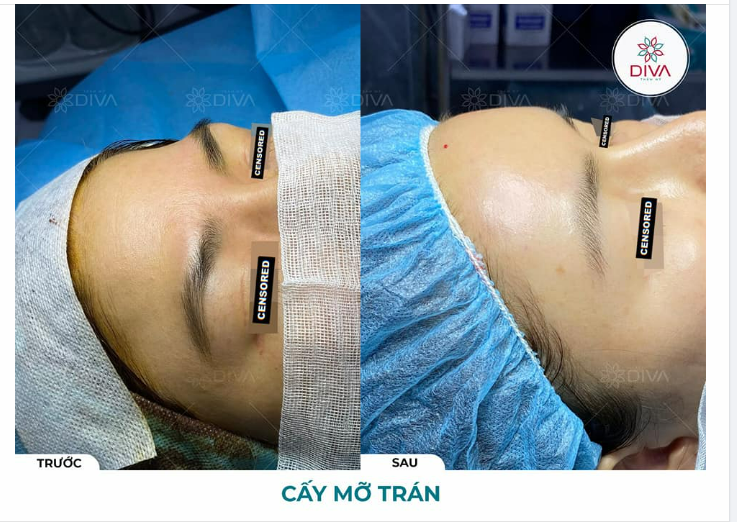 SAU TIÊM MỠ COLEMAN TRÁN CÓ ĐẸP LIỀN KHÔNG?