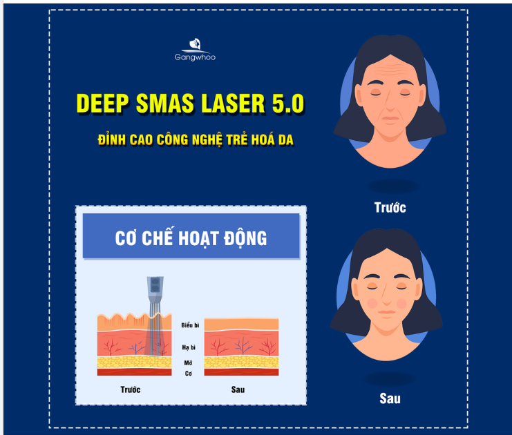 ĐỈNH CAO TRẺ HÓA DA GỌI TÊN CÔNG NGHỆ DEEP SMAS LASER