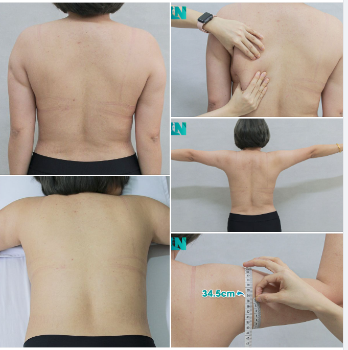  HÚT MỠ TẠO DÁNG THẨM MỸ, CÂN CHỈNH DÁNG VÓC