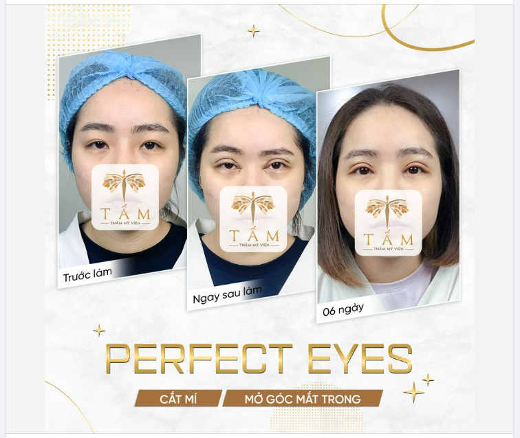 Nâng cấp đôi mắt - Thăng hạng nhan sắc. Perfect Eyes - Cắt mí & Mở góc mắt trong