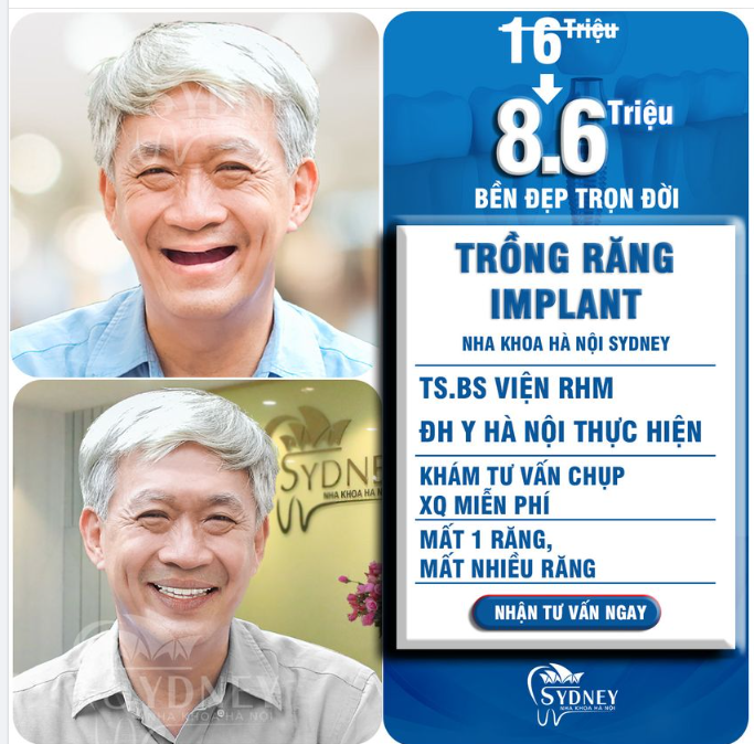 Ưu đãi cấy ghép implant chỉ 8,6 triệu/trụ
