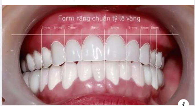 5 tiêu chuẩn hàm răng đẹp tự nhiên mà bạn nên biết