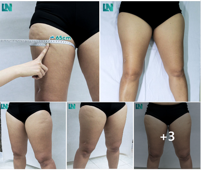  HÚT MỠ TẠO DÁNG THẨM MỸ VÙNG ĐÙI CHO CHỊ KH 36 TUỔI