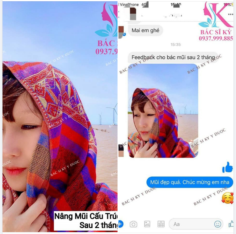 FEEDBACK Khách hàng nâng mũi ALINE cấu trúc SAU 2 THÁNG