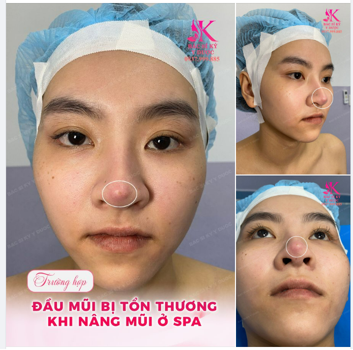 CẢNH BÁO NÂNG MŨI Ở SPA - THỦNG ĐẦU MŨI SAU 2 NĂM
