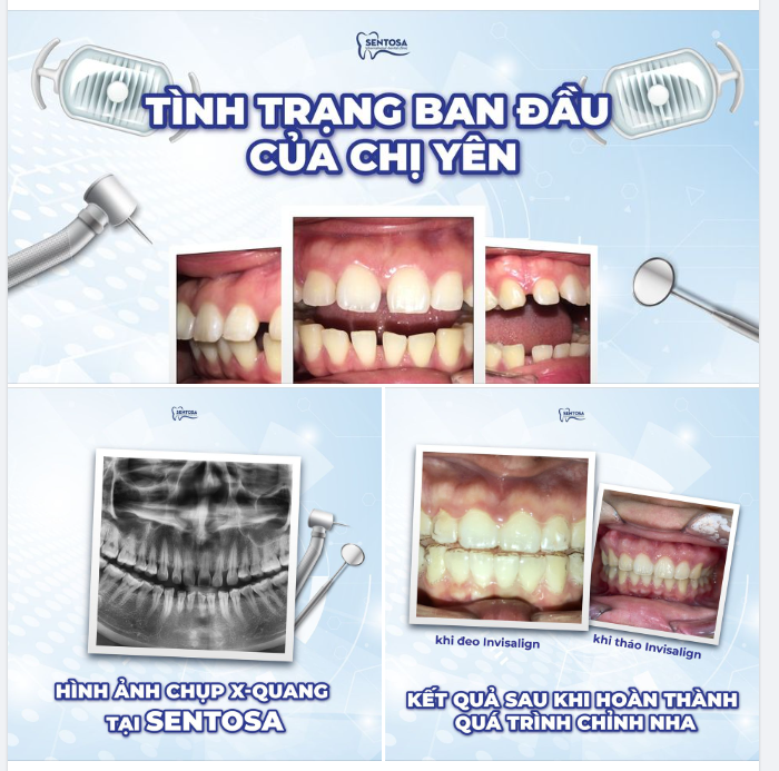 TỰ TIN HƠN MỖI NGÀY KHI NIỀNG RĂNG TẠI SENTOSA