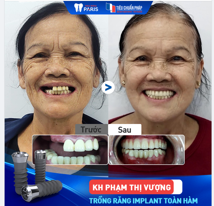 Cảm ơn bác Vượng đã tin tưởng và lựa chọn dịch vụ cấy ghép Implant All On tại Viện Trồng răng Implant Paris.