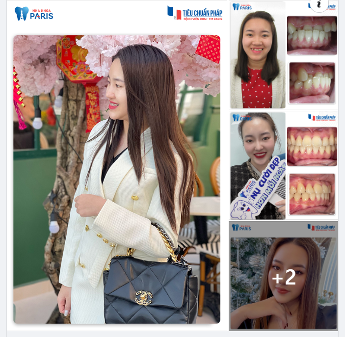 Tháo Niềng Ai Cũng Là Mỹ Nhân