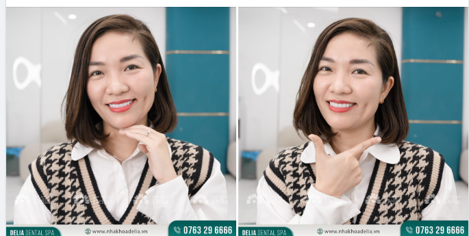Đó là những lời chia sẻ của chị Bích Hà sau 1 năm bén duyên thẩm mỹ răng sứ tại nha khoa Delia.