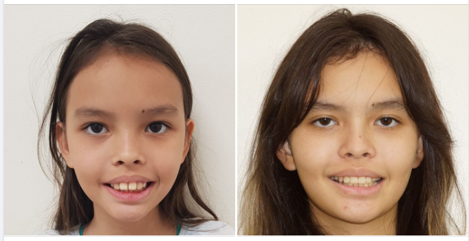 Một ca niềng Invisalign cho trẻ em tại nha khoa Lan Anh 149 Tôn Dật Tiên, Q.7!