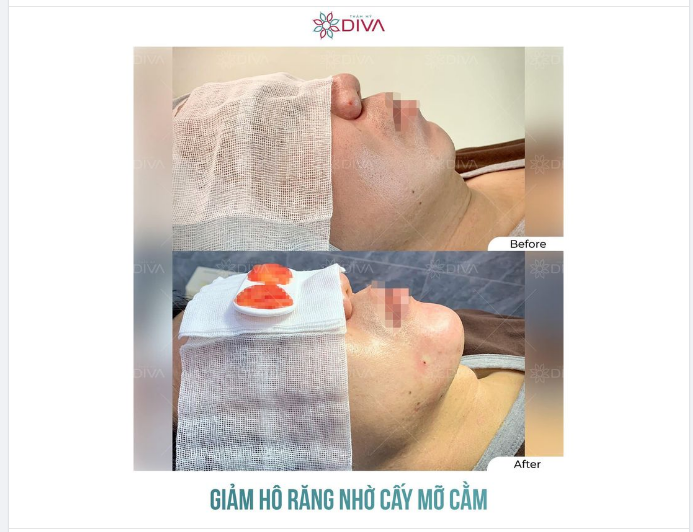 MIỆNG GIẢM HÔ, SỞ HỮU CẰM VLINE SAU TIÊM MỠ COLEMAN