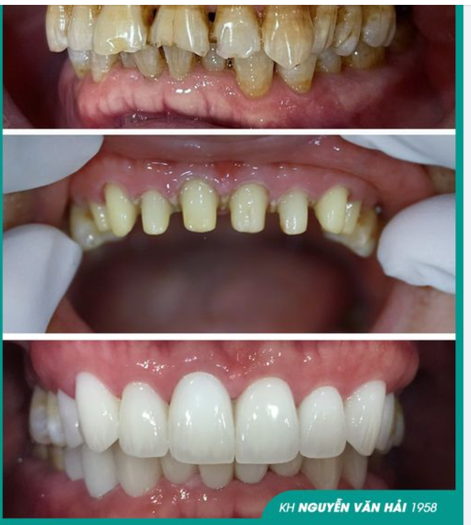 U70 LẤY LẠI PHONG ĐỘ NGÚT NGÀN SAU THẨM MỸ 16 RĂNG SỨ CERAMILL