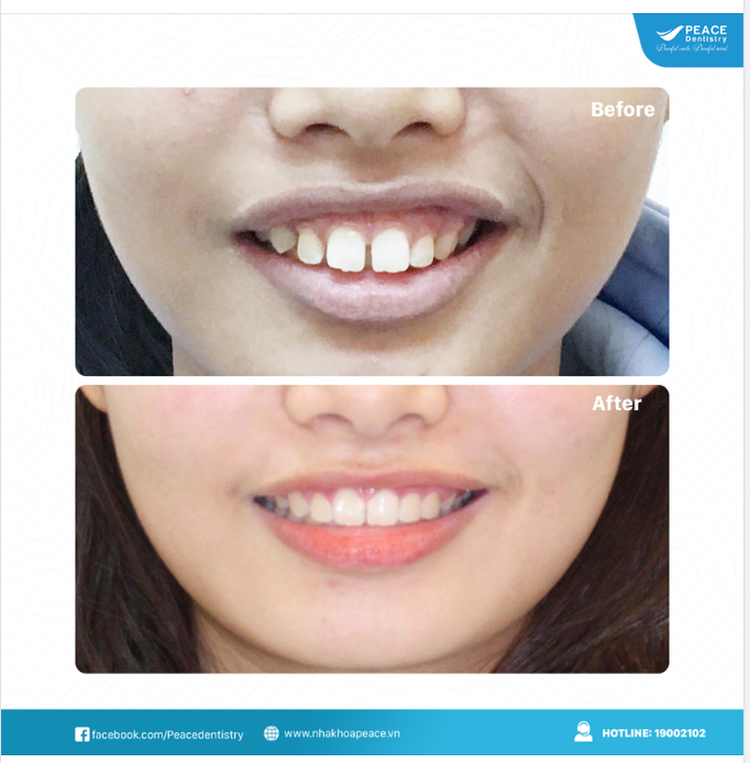 Ca lâm sàng niềng răng chỉnh hô (không nhổ răng, hoàn thành trong 24 tháng)