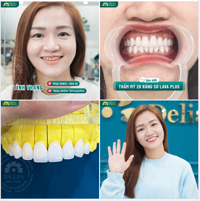 48H - Xử lý răng nhiễm Tetracycline cho chị Bùi Thanh