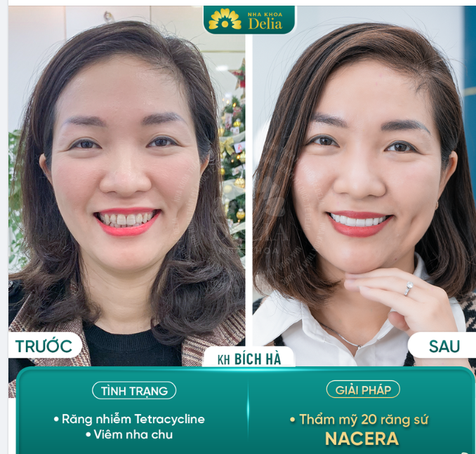 KHOÁC LỚP ÁO MỚI CHO MEN RĂNG NHỜ THẨM MỸ 20 RĂNG SỨ NACERA