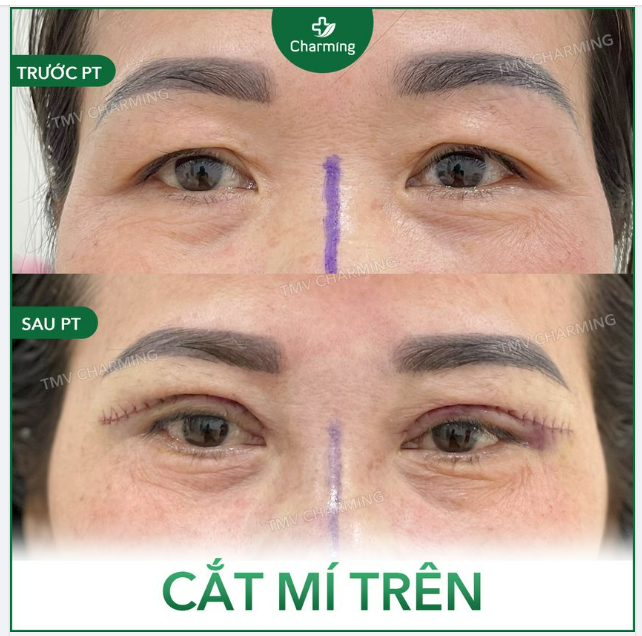 Một trường hợp sụp mí điển hình của những người phụ nữ đã bước qua tuổi 45.