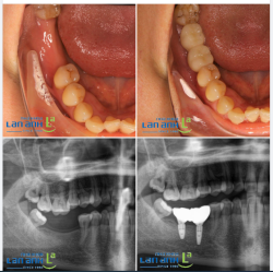 1 ca cấy ghép implant, phục hồi răng mất của BS Vũ chi nhánh Sala, quận 2