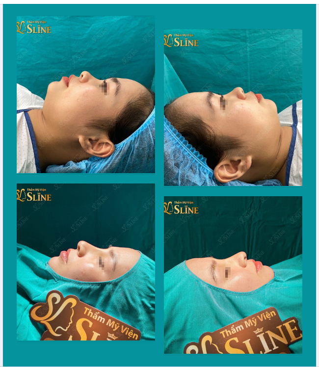 DỨT ĐIỂM MŨI NGẮN ,THẤP SỞ HỮU NGAY DÁNG MŨI CAO,THANH THOÁT