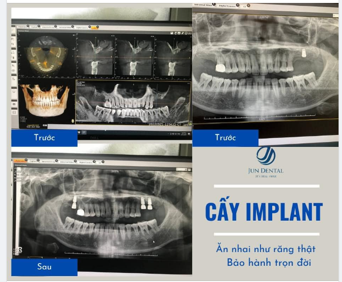 CẤY GHÉP 3 RĂNG IMPLANT LẤY LẠI PHONG ĐỘ VÀ KHẢ NĂNG ĂN NHAI HOÀN HẢO CHÚ BIÊN