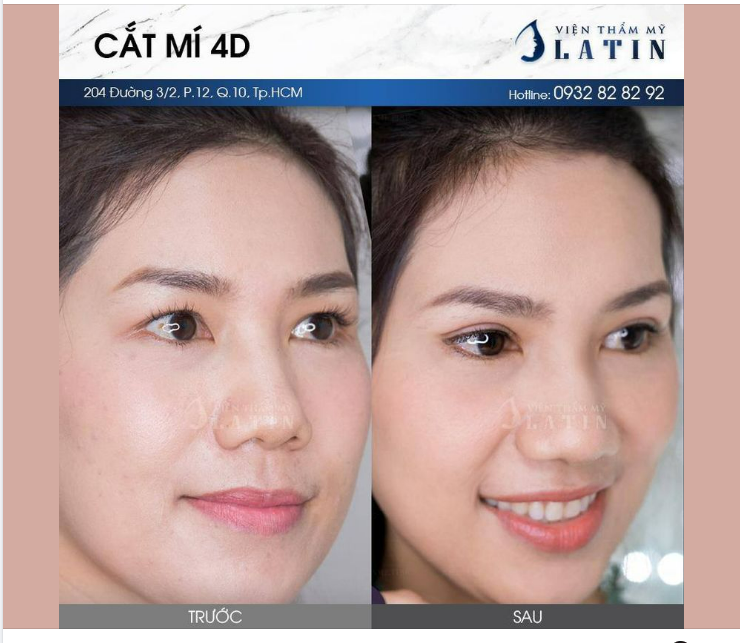 ƯU ĐÃI CẮT MẮT 2 MÍ CHỈ TỪ 7 TRIỆU