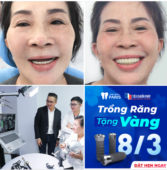 TRỒNG RĂNG NHẬN QUÀ THẢ GA